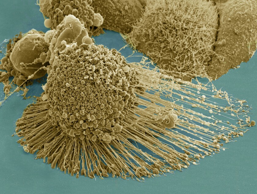 Electron micrograph of a dying cervical cancer cell, from the HeLa cell line.