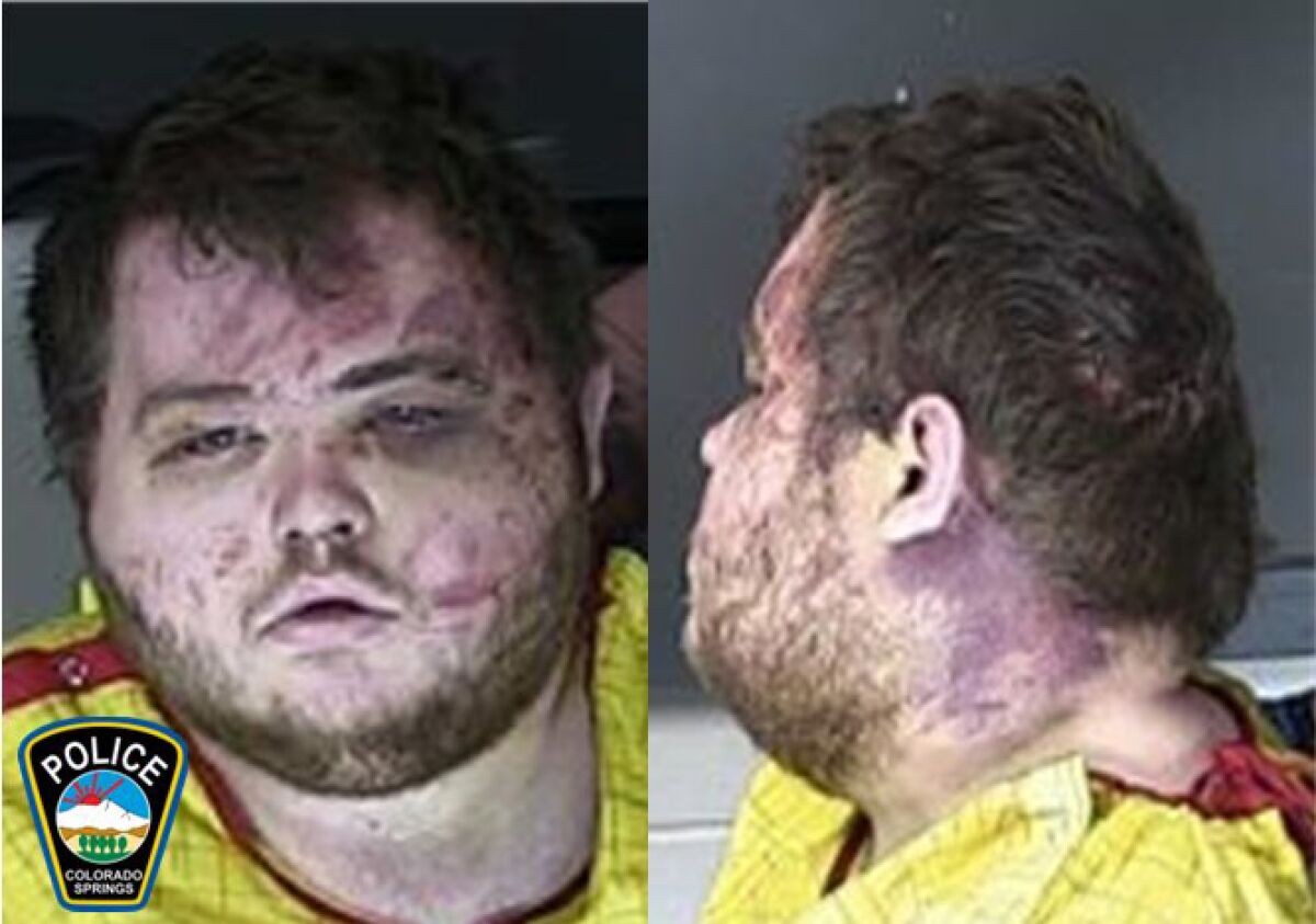 Front and side view of a man with bruises on his face 