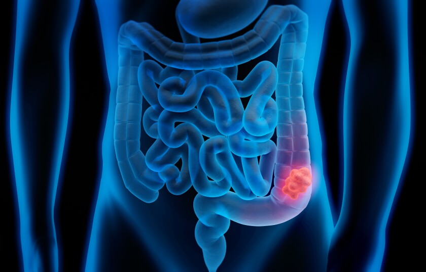 A medical illustration depicts a cancerous polyp inside a colon. 