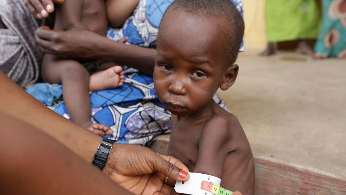 A doctor attends to a malnourished child in 2015 at a refugee camp in Yola, Nigeria.