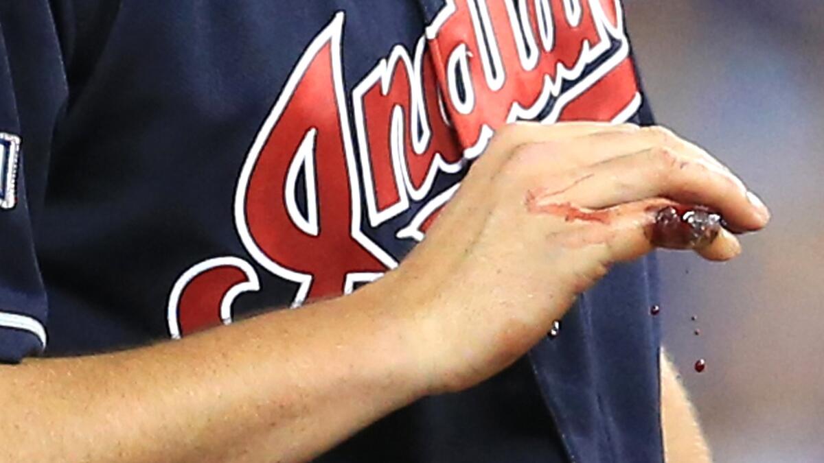 Trevor Bauer's pinky finger bleeds during Game 3 of the American League Championship Series.