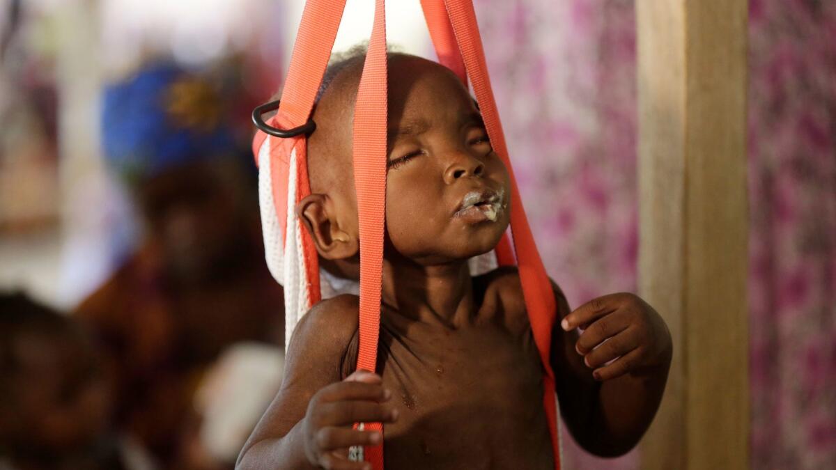 This 2016 file photo shows a malnourished child being weighed on a scale at a clinic run by Doctors Without Borders in Maiduguri, Nigeria.