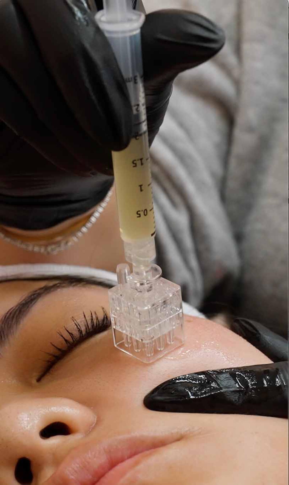 PRFM (platelet-rich fibrin matrix)