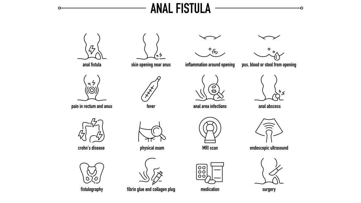 Anal Fistula symptoms, diagnostic and treatment vector icon set. Line editable medical icons.