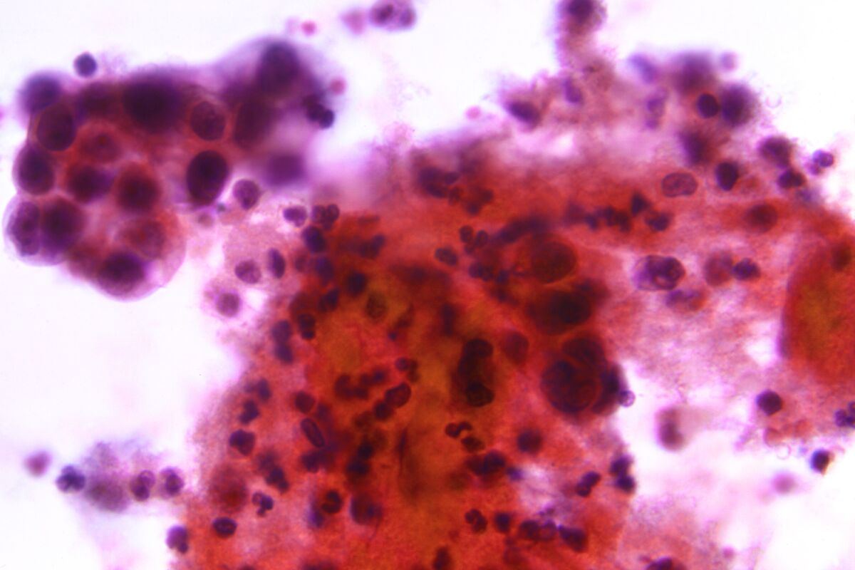 This undated microscope photo made available by the Centers for Disease Control and Prevention shows the results of a Papanicolaou test, or Pap test, with a positive indication for the presence of uterine cervical adenocarcinoma, classified as Stage-III. According to a study published in the journal JAMA Oncology on Thursday, May 5, 2022, researchers found that overall uterine cancer death rates in the U.S., increased by 1.8% per year from 2010 to 2017. (CDC via AP)
