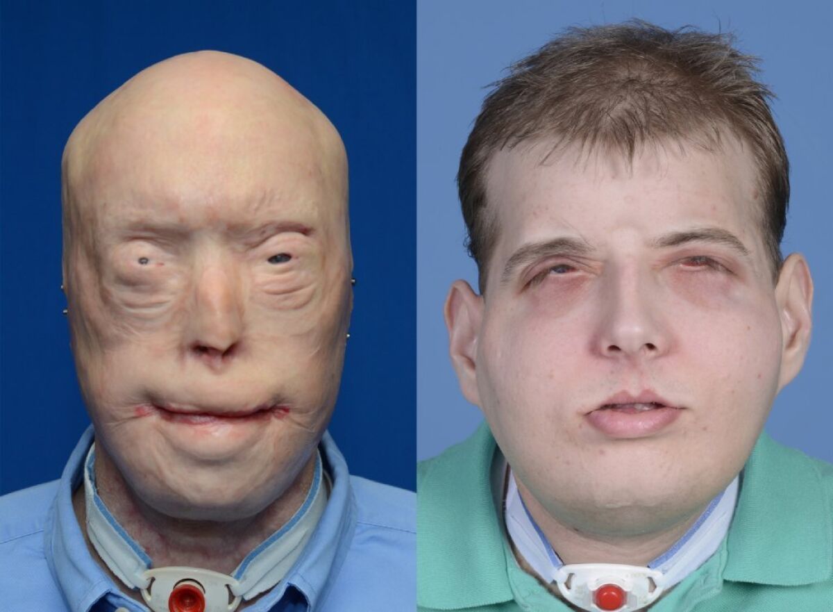 Facial transplant patient Patrick Hardison, a Mississippi firefighter, is seen here before and several weeks following his surgery. Now 93 days after his surgery, the patient has shown no signs of rejecting the facial tissue donated by a 26-year-old bike messenger who was declared brain-dead after an accident.