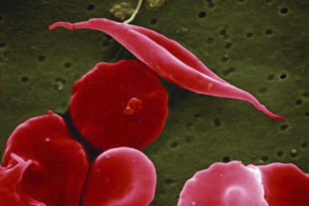 This electron microscope image shows a blood cell altered by sickle cell disease, top.