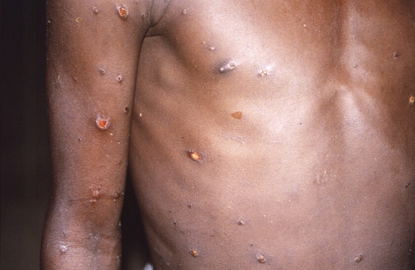 El brazo derecho y el torso de una persona con un caso activo de viruela símica. (CDC via AP)