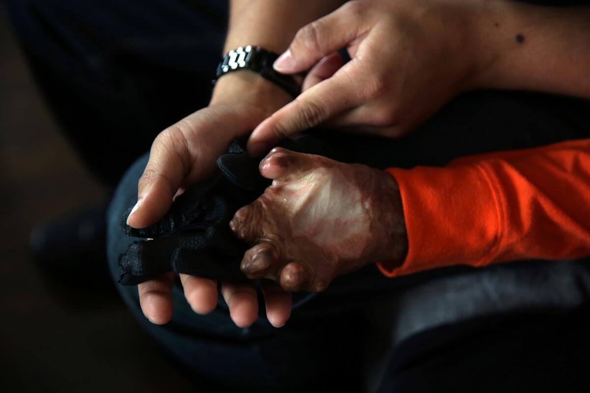 Austin Conrad checks the size of Julian Reynoso's hand to fit him for a prosthetic.