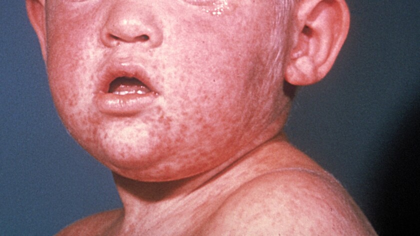 A boy with measles