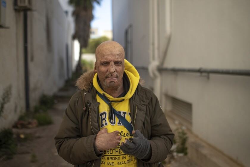 Hosni Kalaeyah, 49, a protester who self immolated during Tunisia's democratic uprising 10 years ago, poses for a portrait in Tunis, Tunisia, Tuesday, Jan. 12, 2021. Kalaeyah set himself on fire during the uprising. Now 49, Kalaeya lives with permanent scars on his face and missing fingers. (AP Photo/Mosa'ab Elshamy)