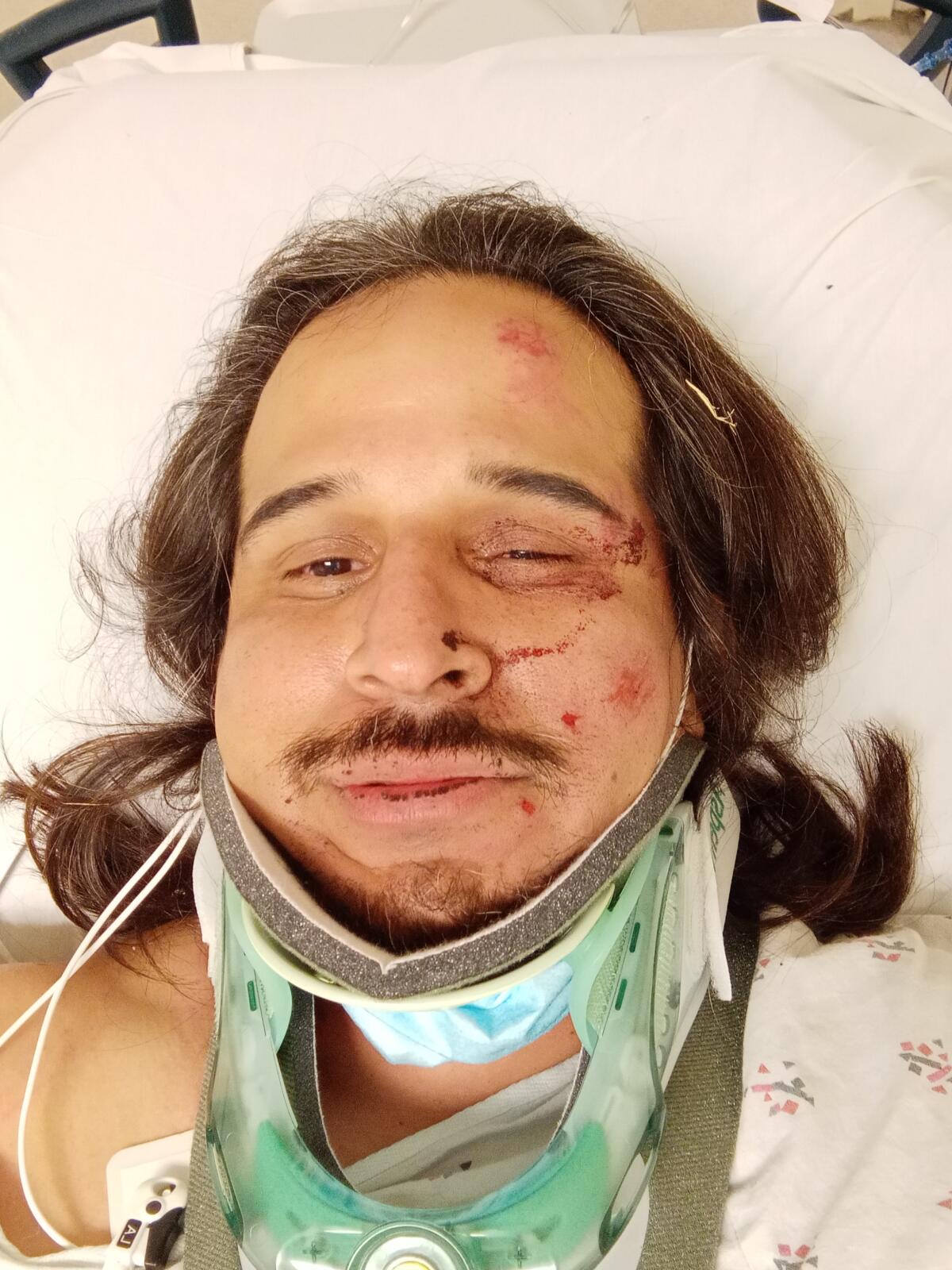 A man with facial injuries in a hospital bed