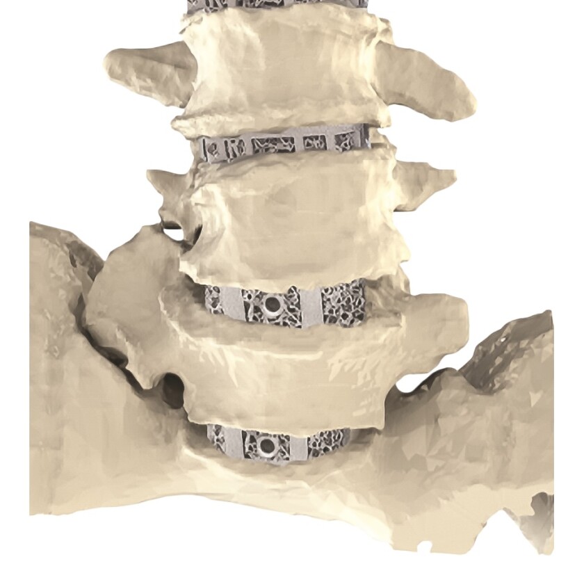 Carlsmed has developed technology that enables personalized medicine in complex spine surgeries.