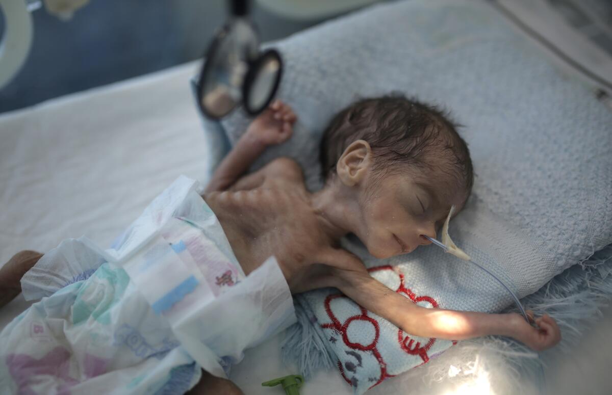 In this Nov. 23, 2019 file photo, a malnourished newborn baby lies in an incubator at Al-Sabeen hospital in Sana, Yemen. 