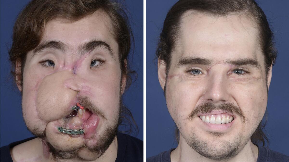 Cameron Underwood's suicide attempt in 2016 left his face horribly disfigured, left. After facial transplant surgery early this year, his new face should be "pristine" in as little as three years, the chief surgeon said.