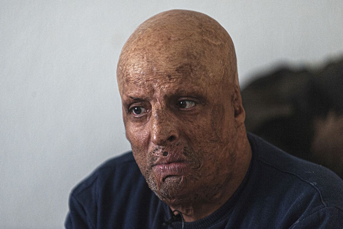 Hosni Kalaia spent three years in a hospital and then a private clinic recovering from his burns.