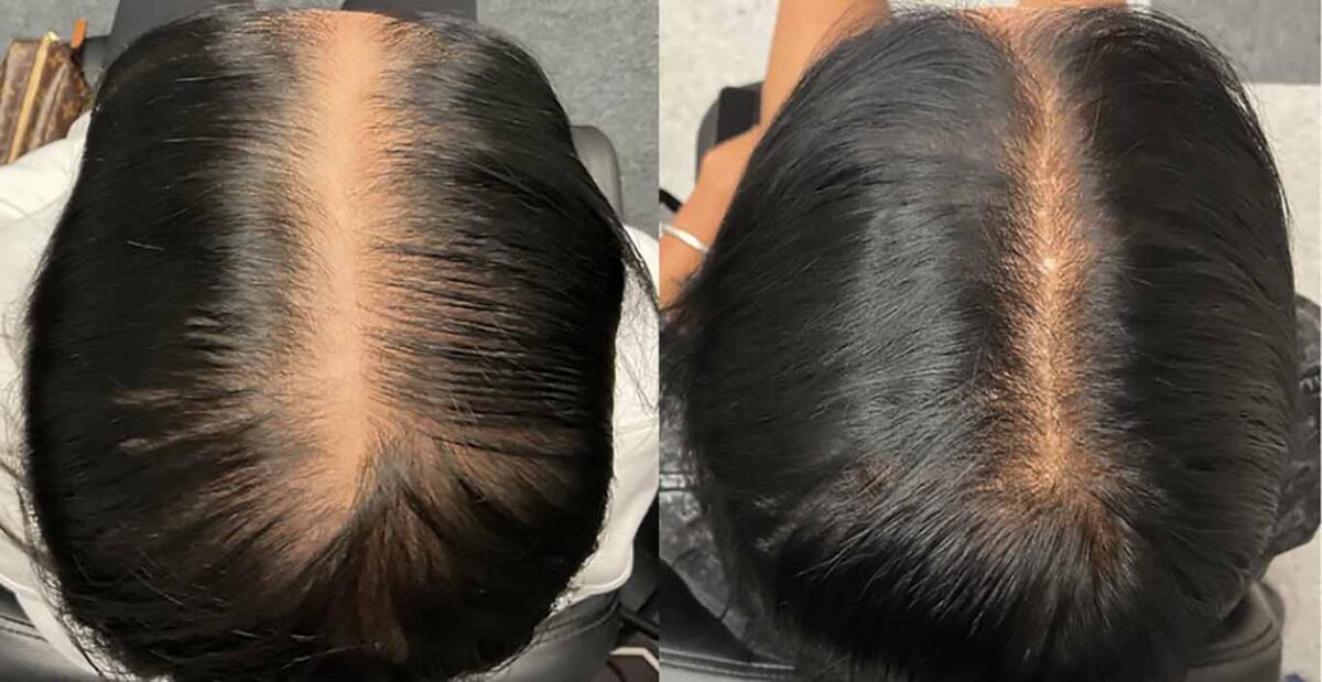 Laser Hair Restoration Without Surgery Is Reshaping the Future of Hair Regrowth: TED by Alma