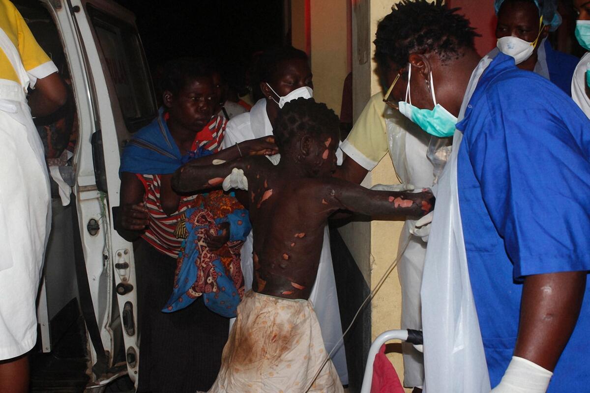 A badly burned child arrives at the Provincial Hospital in Tete after a fuel tanker exploded in Mozambique.