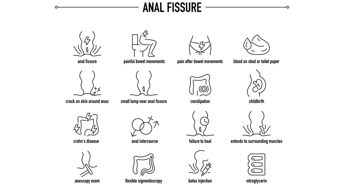 Anal Fissure symptoms, diagnostic and treatment vector icon set. Line editable medical icons.