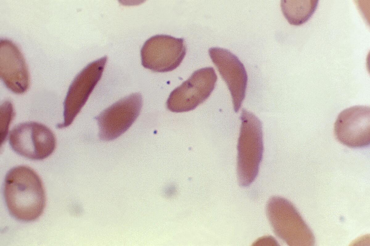 Red blood cells from a sickle cell disease patient