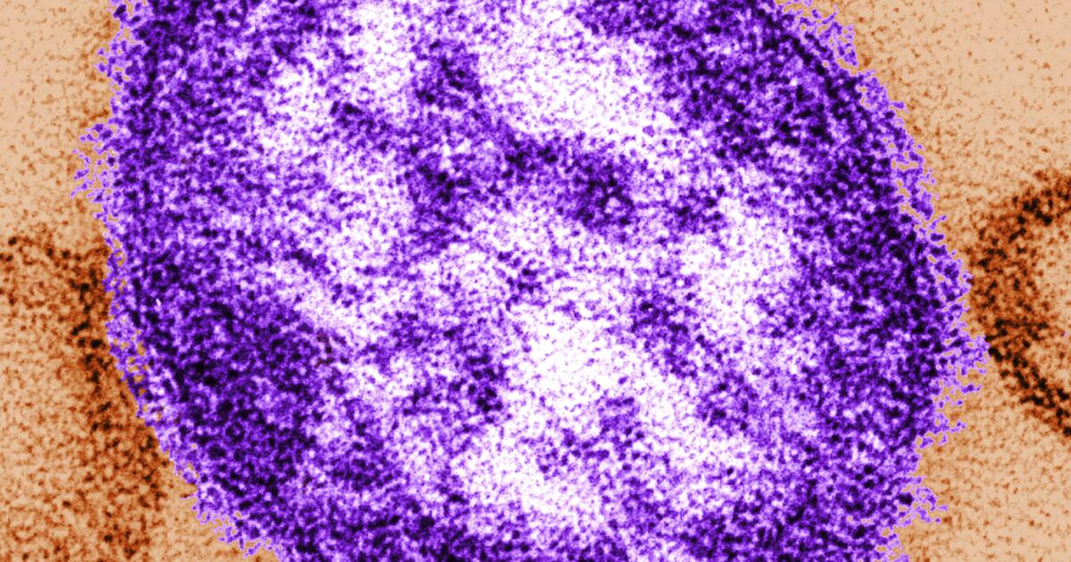 Traveler contaminated with measles flew into LAX, visited Orange County