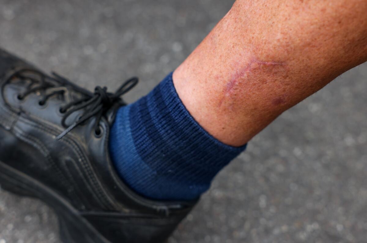 Long Beach mail carrier Mimi Ritz has a scar above her right ankle after suffering a dog bite.