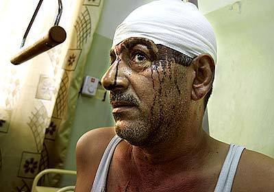 Dried blood coats the face of an Iraqi policeman in the Al Yarmook hospital after a car bomb exploded near a police station in the Seidiyeh neighbourhood in Baghdad today.