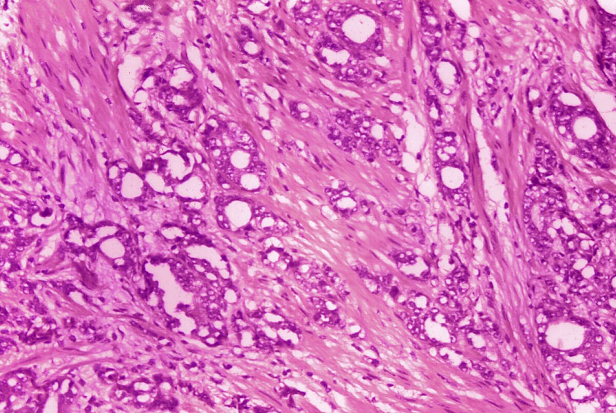 FILE - This 1974 microscope image made available by the Centers for Disease Control and Prevention shows changes in cells indicative of adenocarcinoma of the prostate. Some doctors say it’s time to rename low-grade prostate cancer to eliminate the alarming C word. About 34,000 Americans die from prostate cancer annually, but most prostate cancers are harmless. A paper published Monday, April 18, 2022 in the Journal of Clinical Oncology is reviving a debate about dropping the word “cancer” when patients learn the results of these low-risk biopsy findings. (Dr. Edwin P. Ewing, Jr./CDC via AP)