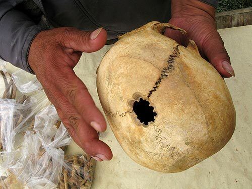 This skull, from an adult woman, is one of many unearthed in the dig at Kuelap. The Chachapoya, who thrived for centuries, declined suddenly in the first half of the 16th century. which has confounded experts. The Chachapoya suffered a demographic catastrophe in a short period of time, said chief archaeologist Alfredo Narvaez, noting that the population had probably dropped from several hundred thousand to perhaps 10,000 by the mid-16th century, after the arrival of the Spanish in Peru. Evidence of a possible final calamity at Kuelap has been found in a platform near the Plaza Mayor, where excavators discovered scores of randomly scattered skeletons, of all ages and both sexes, mixed amid daily utensils. This was a striking departure in a culture in which departed loved ones were treated with great care and ceremony.