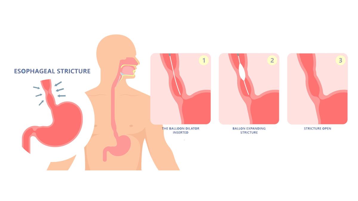 Dysphagia infection trachea examine Surgery choking gastric diagnose windpipe disorder.