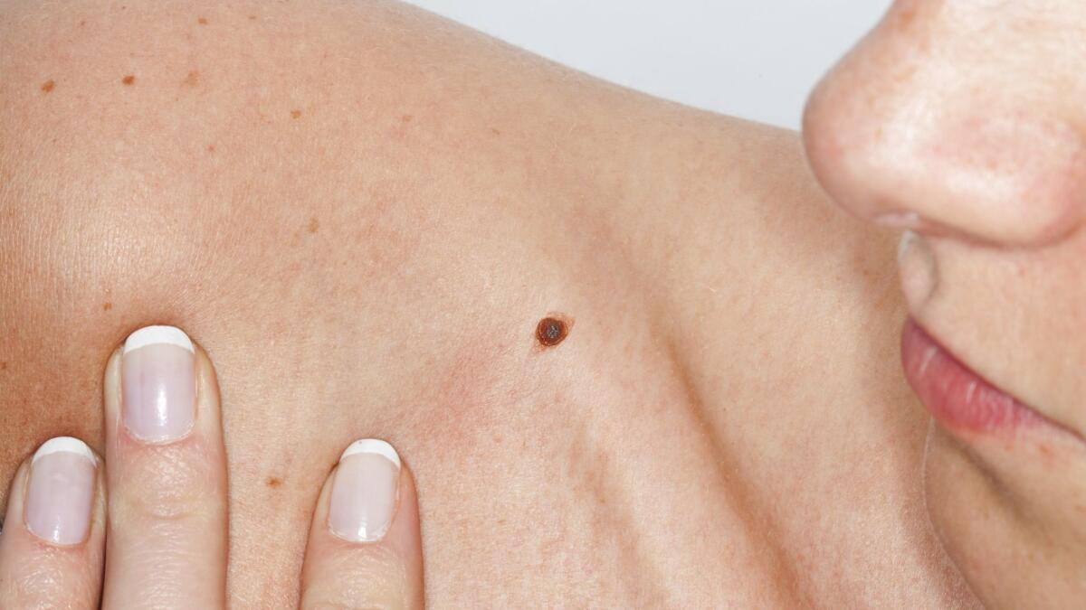 New research finds that weight-loss surgery is associated with a reduced risk of melanoma.