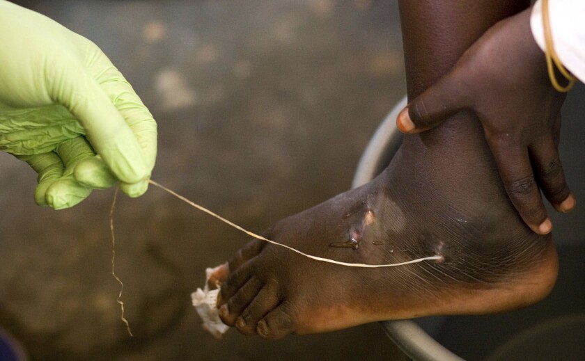 FILE - In this March 9, 2007, file photo, a Guinea worm is extracted by a health worker from a child's foot at a containment center in Savelugu, Ghana. The number of people infected with Guinea worm dropped to just over a dozen worldwide in 2021 as health workers try to eradicate the disease. (AP Photo/Olivier Asselin, File)