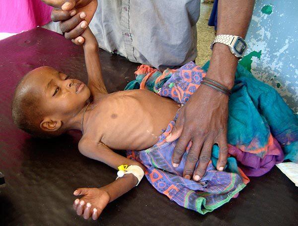 Child malnutrition in Somalia