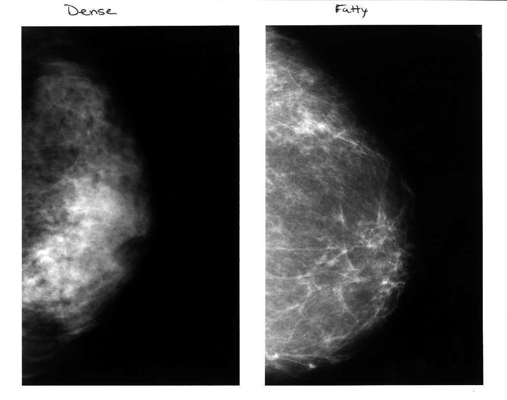 How often should you get a mammogram? It depends on whether you