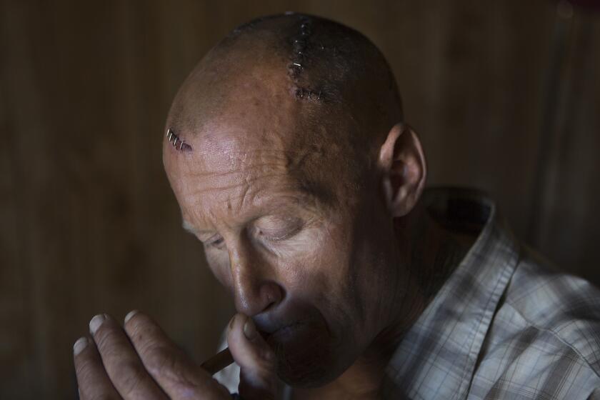 John Stephen Wood lights up a cigarette in the Ventura hotel room where he is recovering after being beaten and stabbed by attackers.