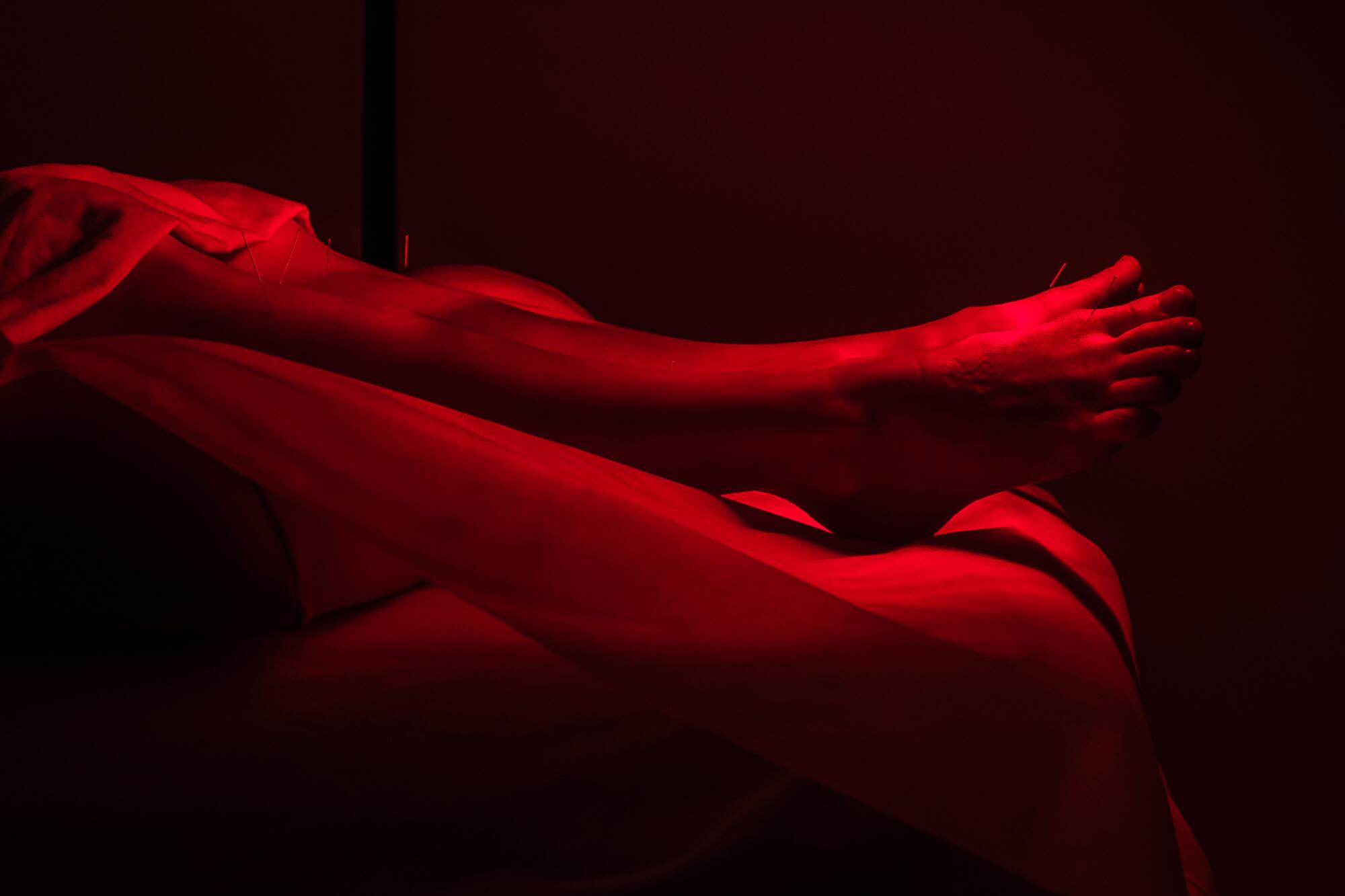 Rachael Lackner lies on a table while a heat lamp is placed over her legs with acupuncture needles.