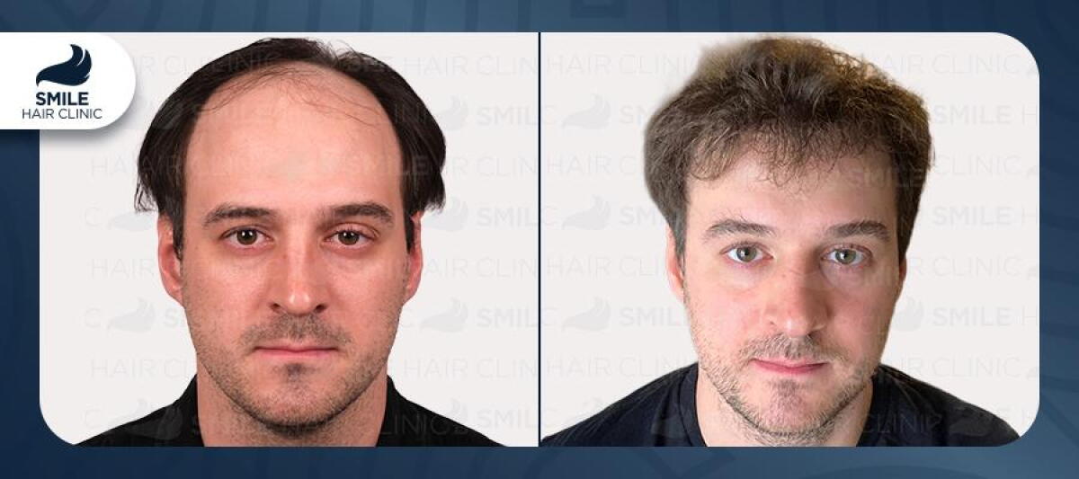Scenes from Smile Hair Clinic in Instanbul, Turkey