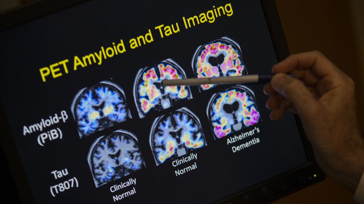 A doctor points to PET scan results that are part of a study on Alzheimer's disease at a hospital in Washington in 2015.
