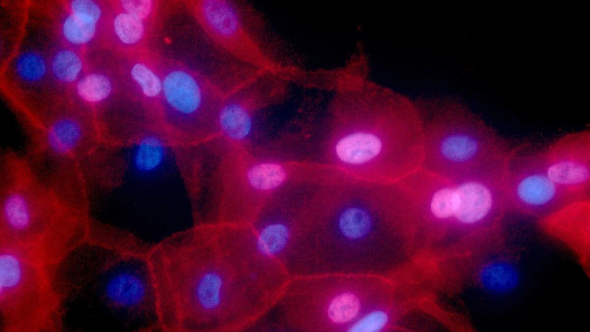This fluorescence-colored microscope image made available by the National Institutes of Health in September 2016 shows a culture of human breast cancer cells.