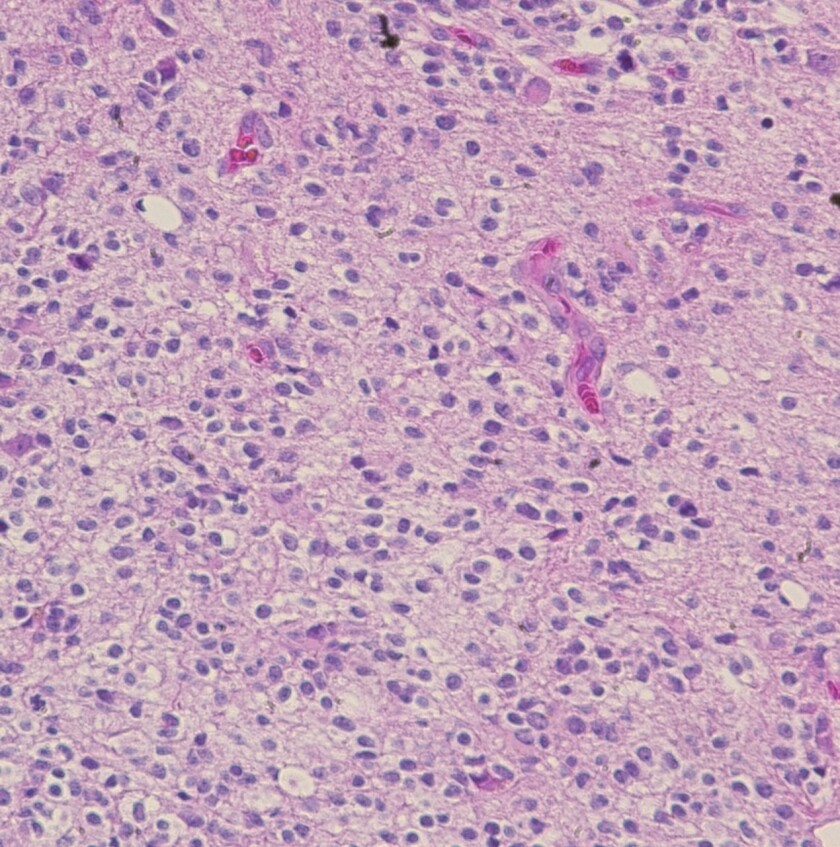 Tissue from a brain tumor known as an oligodendroglioma. Genes from such tumors can be inserted into microbes to help make a chemical precursor to nylon.