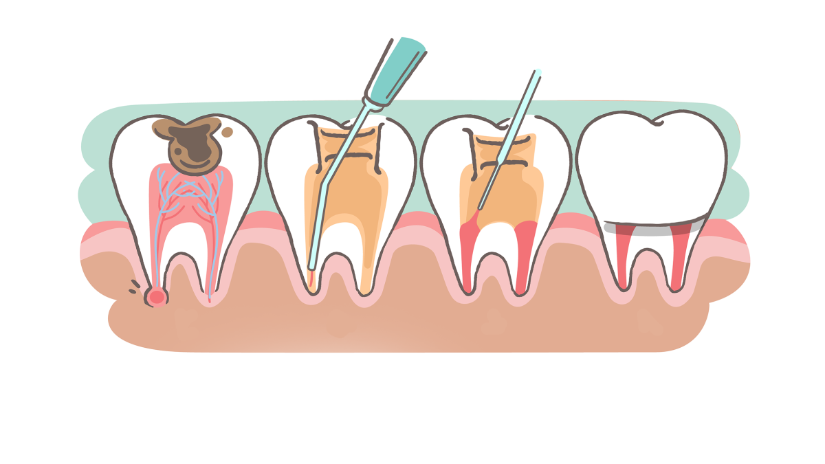 Root Canals: Procedure, Tooth Pain, Treatment and Aftercare Tips - Los ...