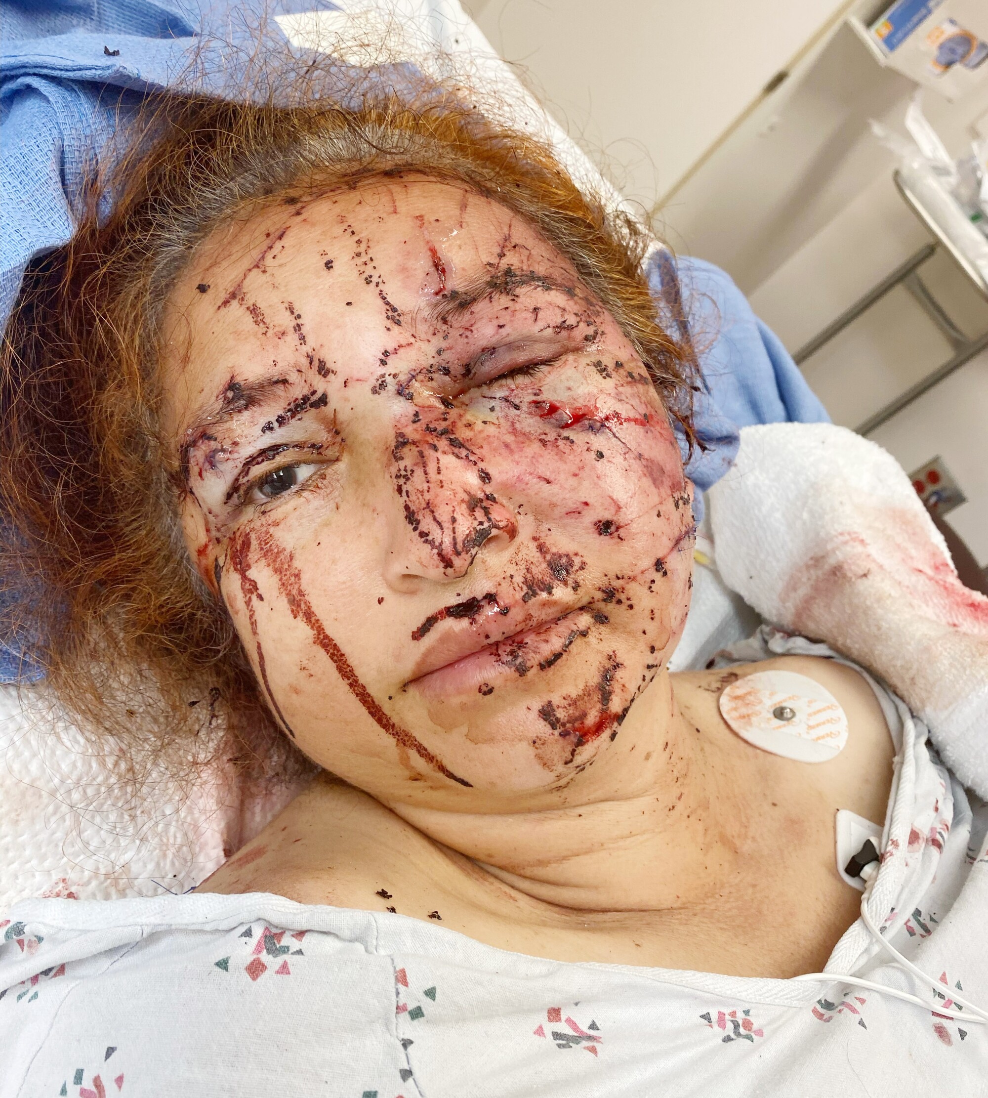 A woman in a hospital gown with cuts and blood on her face