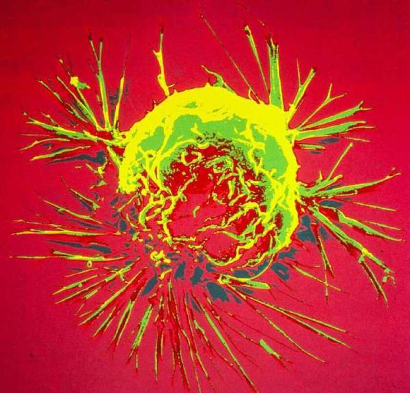 Shown is a scanning electron microscope image of a breast cancer cell.