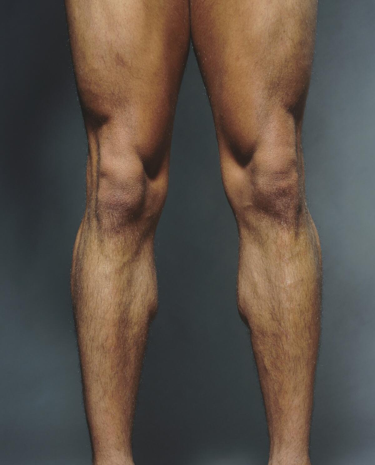 A new study concludes that glucosamine supplementation does not prevent deterioration of knee cartilage or reduce knee pain.