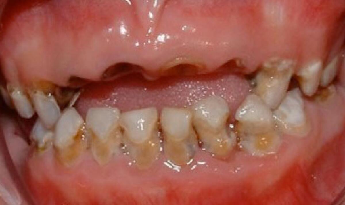 This is the mouth of a 3-year-old child showing severe dental disease