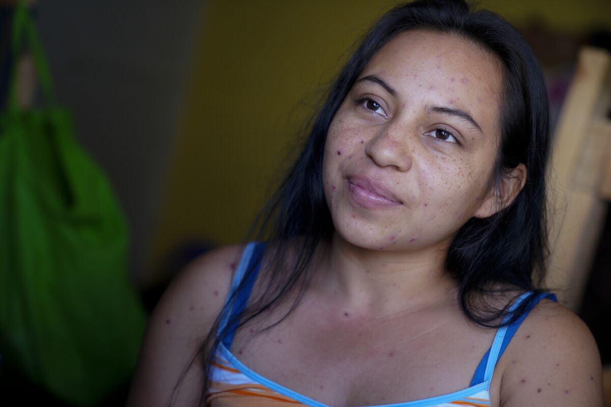 A woman who has chicken pox and preferred to not use her name remained in isolation on August 15, 2019 at the Agape World Mission shelter in Tijuana, Mexico.