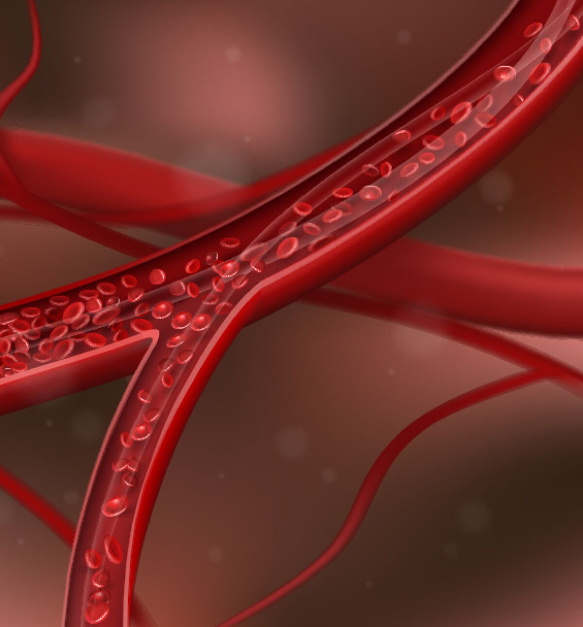 Artery blocked by cholesterol. Vector illustration
