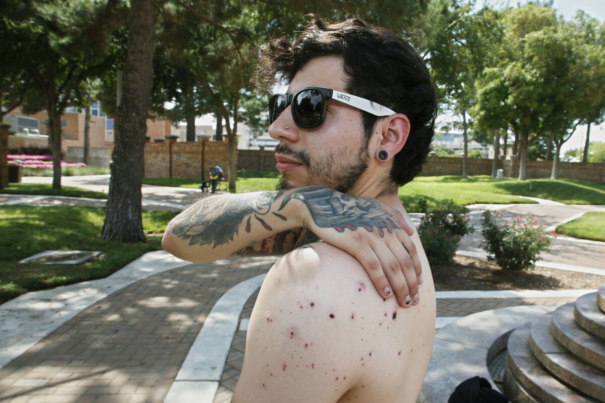 Daniel Munoz shows where his shoulder is still pocked with bullet fragments from the Aug. 31 shooting in Texas.