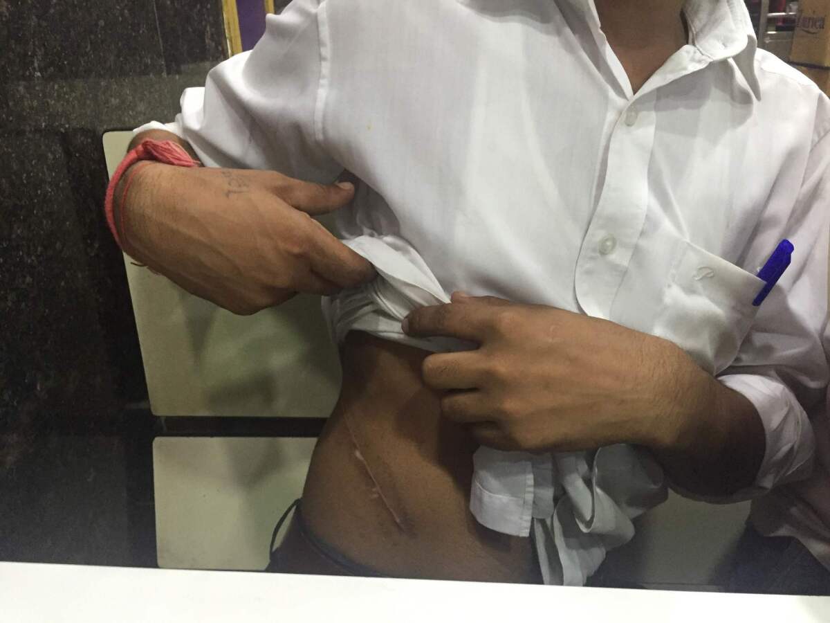 Sundar Singh Jatav, 23, shows the scar from his kidney operation.