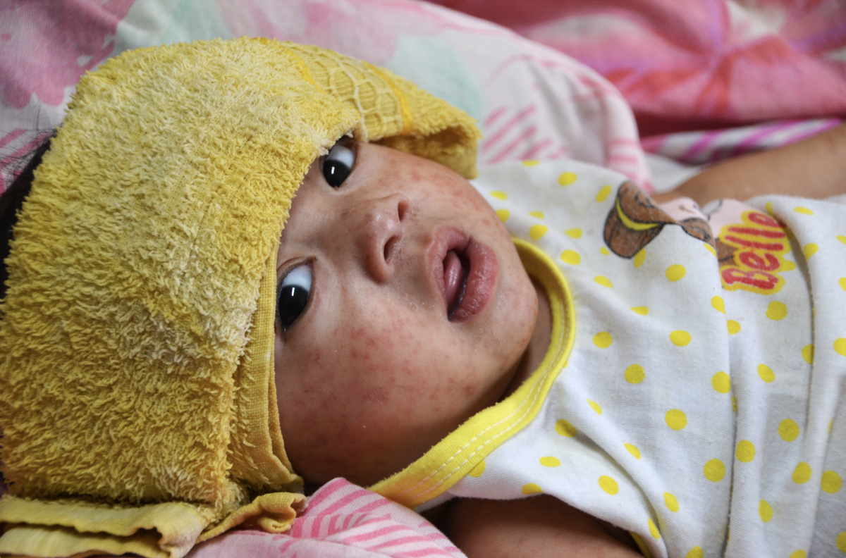 A baby with red rashes on their face.